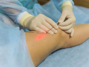 chi phí điều trị suy giãn tĩnh mạch bằng laser